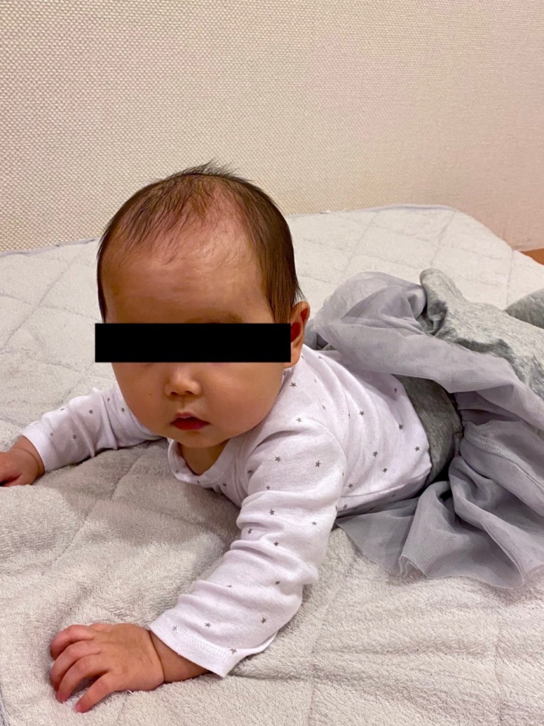 長女6ヶ月乳児湿疹完治の写真
