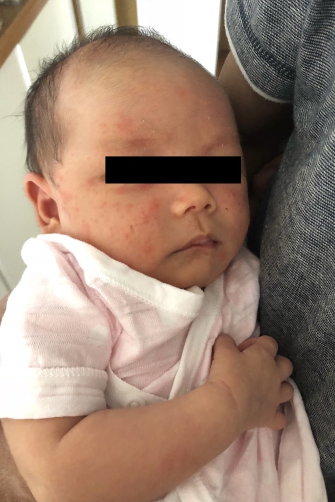 長女1ヶ月の乳児湿疹の写真
